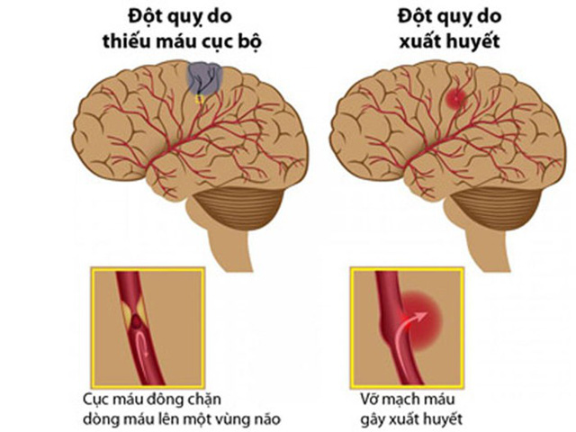 ĐỘT QUỴ XUẤT HUYẾT NÃO: LOẠT NGUYÊN NHÂN GÂY BỆNH ĐÁNG LƯU Ý