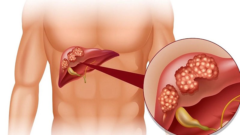 Viêm gan B, nguyên nhân và triệu chứng