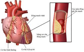 Đau ngực, tức ngực có phải là nguy cơ nhồi máu cơ tim