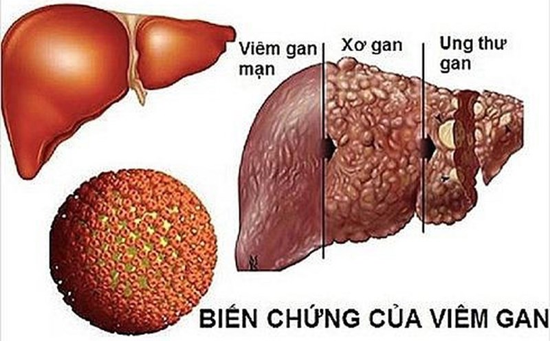 Một số triệu chứng của bệnh ung thư gan