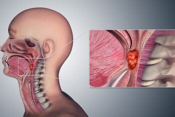 “Cảnh báo” các triệu chứng của ung thư vòm họng