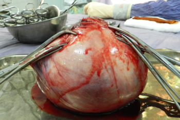 Phẫu thuật lấy khối u hơn 2kg trong bụng bệnh nhân.