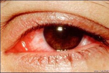 Hà Nội: Bùng phát dịch đau mắt đỏ
