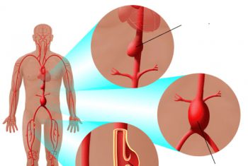 Phồng động mạch, chớ coi thường