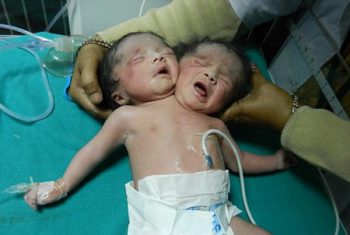 Sinh bé 2 đầu vì không có tiền siêu âm phát hiện dị tật thai nhi