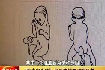 Bé trai 2 tuổi "mang thai" người anh em sinh đôi