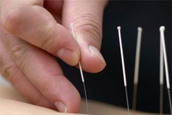 Châm cứu: coi chừng châm xong cấp cứu