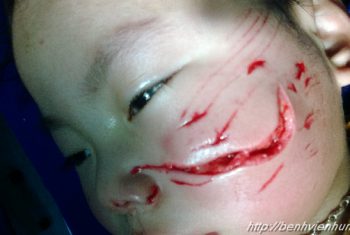 Bé gái 2 tuổi bị chó cắn rách mặt.