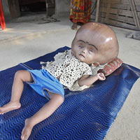 Cô bé có đầu to gấp 3 lần bình thường