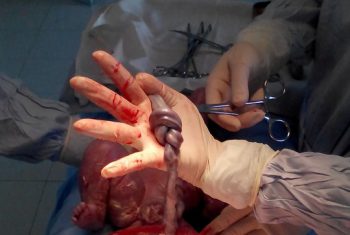 Thai nhi có dây rốn thắt nút 2 vòng vẫn sống sót