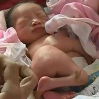 Bị dị dạng bé trai có 4 tay, 4 chân