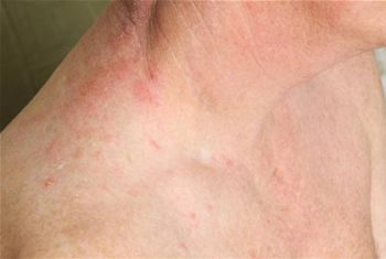 Bệnh “giời leo” làm tăng nguy cơ đau tim và đột quỵ