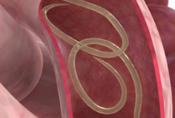 Dễ tử vong do nhiễm giun xoắn