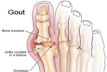 Chẩn đoán và điều trị bệnh gút (Gout)