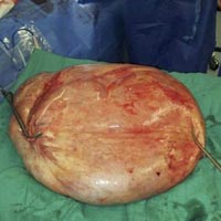 Kinh hoàng khối u tử cung nặng…25kg