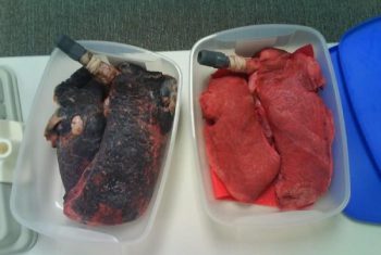 Bác sĩ sốc khi nhìn phổi đen như bồ hóng