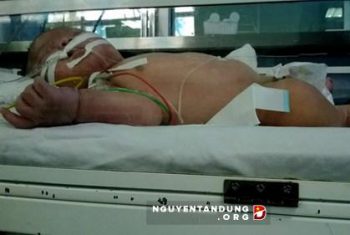 Bé trai 1 tháng tuổi nguy kịch sau khi tiêm phòng lao