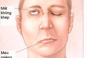 Đề phòng bệnh liệt mặt khi trời trở lạnh