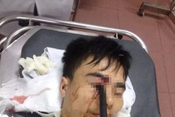 Cầm ô đi xe máy, thanh niên bị cán gương đâm xuyên mắt