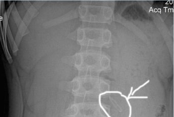 Bác sỹ BV Hùng Vương Nội soi gắp dị vật mắc trong dạ dày bé trai 11 tuổi.