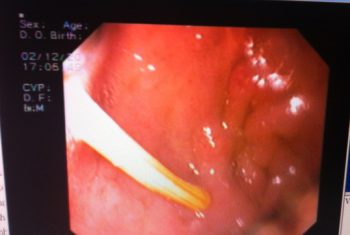 Nuốt tăm nhọn tưởng đau dạ dày?