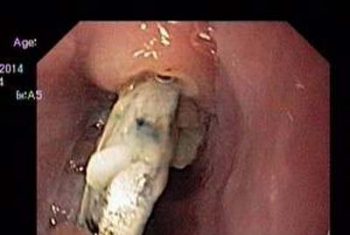 Mổ lấy cục pin nằm trong thực quản bé trai 2 tuổi