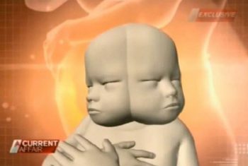 Dính liền hiếm gặp: Bào thai có hai mặt đối xứng nhau