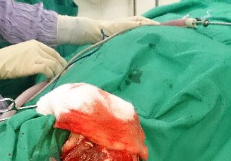 BV Hùng Vương Phẫu thuật thành công bệnh nhân chấn thương sọ não