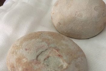 Lấy hai viên sỏi to bằng trứng vịt ra khỏi bàng quang
