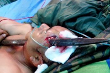 Đang đào đất, bất ngờ bị xà beng đâm xuyên đầu