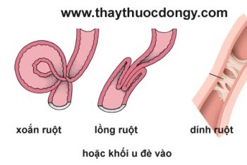 Mổ cấp cứu thành công  bệnh nhân cao tuổi bị tắc ruột