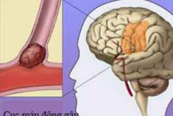 Chủ động phòng ngừa tai biến mạch máu não