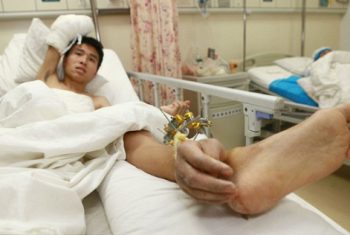 Bệnh nhân gắn tay vào chân trước khi phẫu thuật