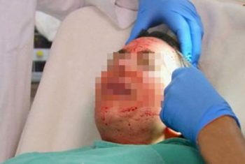 Tiếp cận công nghệ kinh rợn dùng máu người tái tạo da ở Sài Gòn