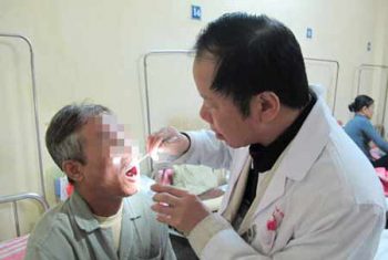 Cắt 2/3 lưỡi vì nghiện thuốc lá