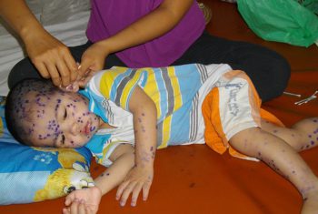 Hết vắc xin ngừa thủy đậu, người bệnh hoang mang