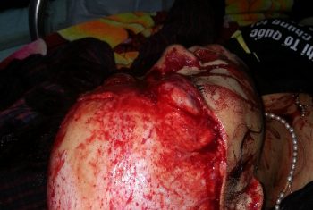 Tai nạn kinh hoàng, da đầu bị lột, hở toàn bộ hộp sọ.