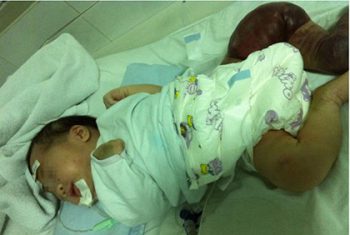 Điều trị thành công trẻ sơ sinh mắc hội chứng u máu hiếm gặp