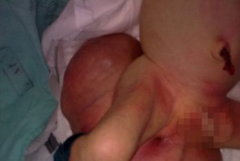 Mổ u quái nặng 1,9 kg cho bé 5 ngày tuổi