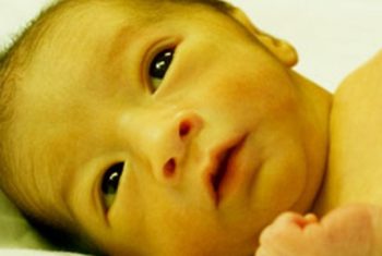 Phân biệt vàng da sinh lý và vàng da bệnh lý ở trẻ sơ sinh