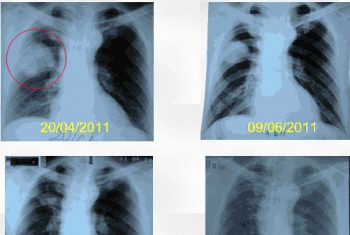 Đốt u phổi bằng sóng cao tần, hi vọng mới của bệnh nhân ung thư