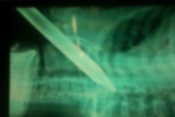 Cứu sống bệnh nhân bị xà beng gần 10kg đâm xuyên cổ