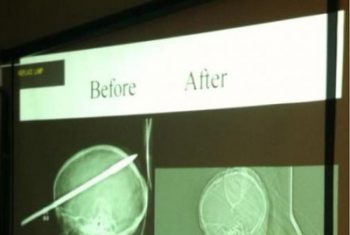 5 bức ảnh X-quang khó tin nhất về các vết thương do dị vật